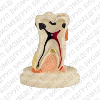 TOOTH MODEL STYPE  модель зуба с выделенными патологическими зонами