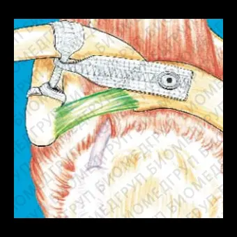 Скоба для остеосинтеза лигаментопластика акромиальноключичного сочленения ACROLIG