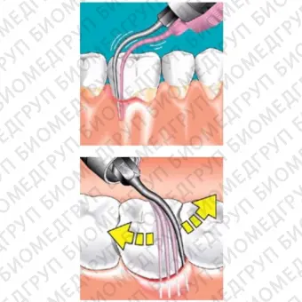 Sonicflex paro 62 A  насадка с рабочим концом, изогнутым вправо с закругленной верхушкой для минимально инвазивной терапии пародонтита