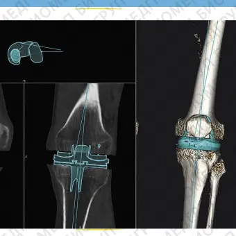 Медицинское программное обеспечение mediCAD 3D Knee