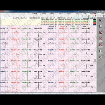 Программное обеспечение для электрокардиографии CVS03
