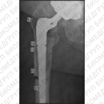 Ортопедическая проволока для контроля протеза бедра Ortholox UHMWPE